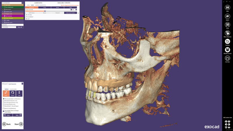 Exocad - Visor Dicom para odontología presentado por Medicai