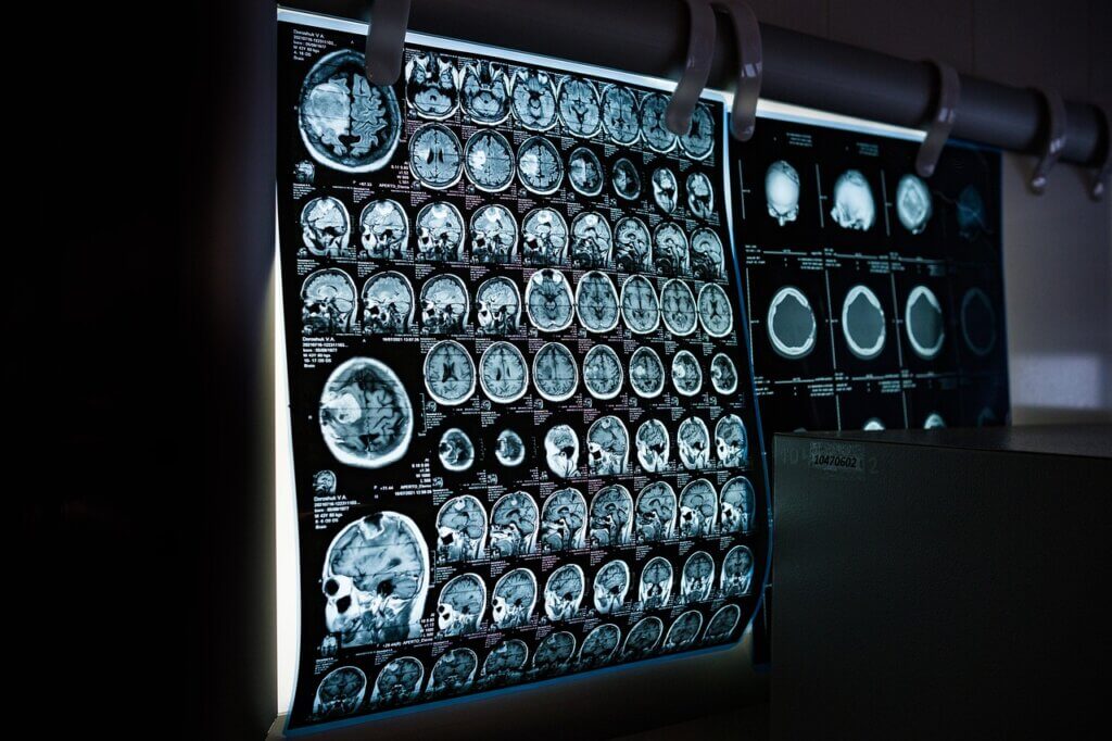 AI-Assisted Neuroimaging Analysis in Modern Psychiatry